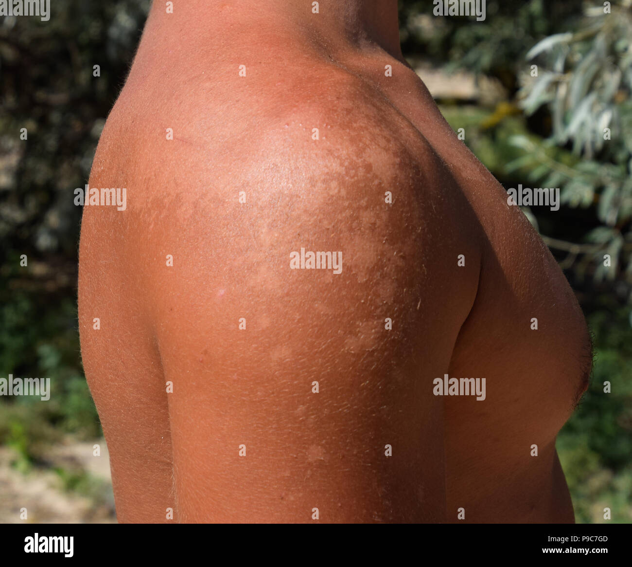 Sunburn on the skin of the shoulders. Exfoliation, skin peels off. Dangerous sun tan. Stock Photo