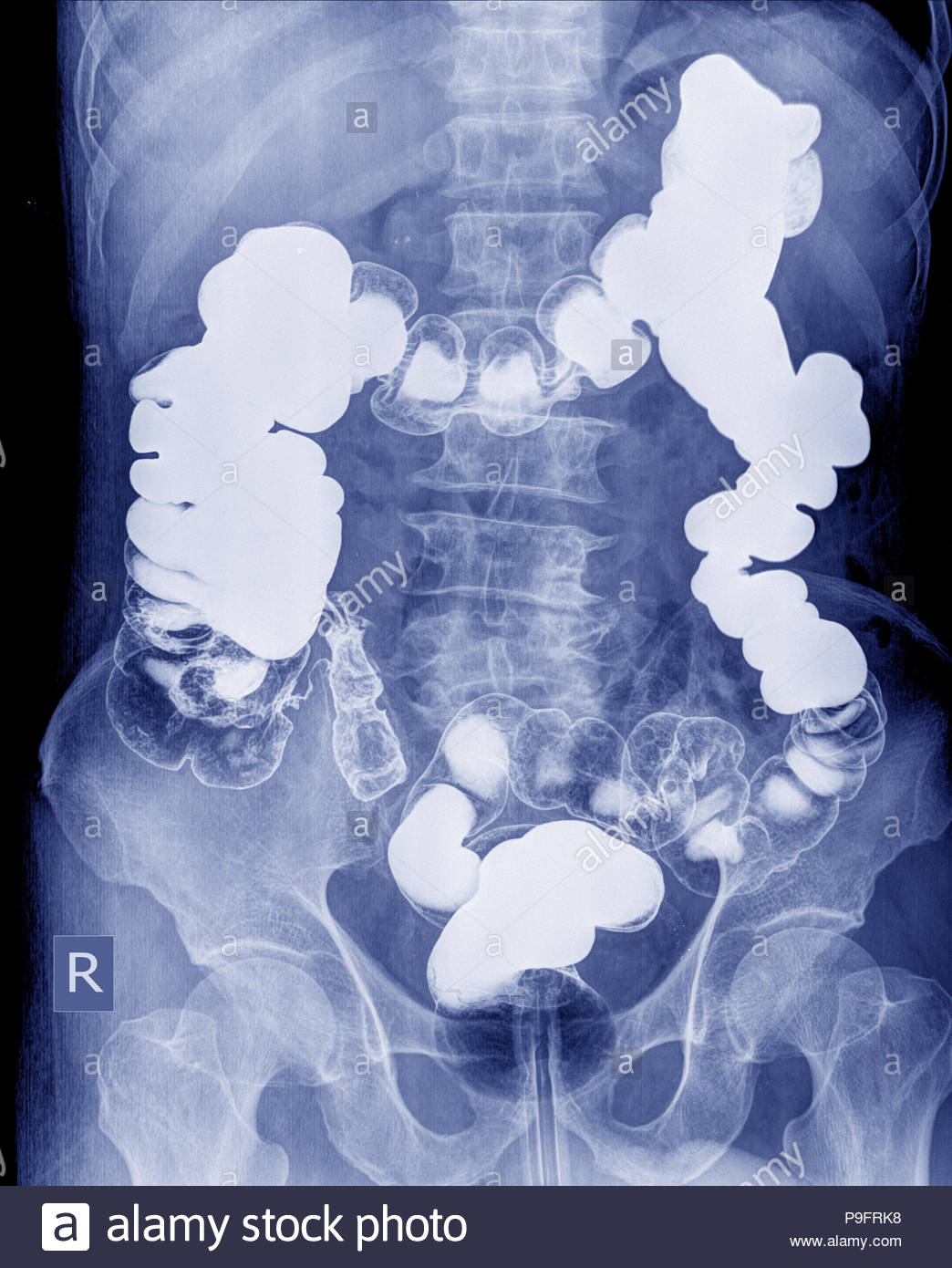 Barium Enema Stock Photos & Barium Enema Stock Images Alamy