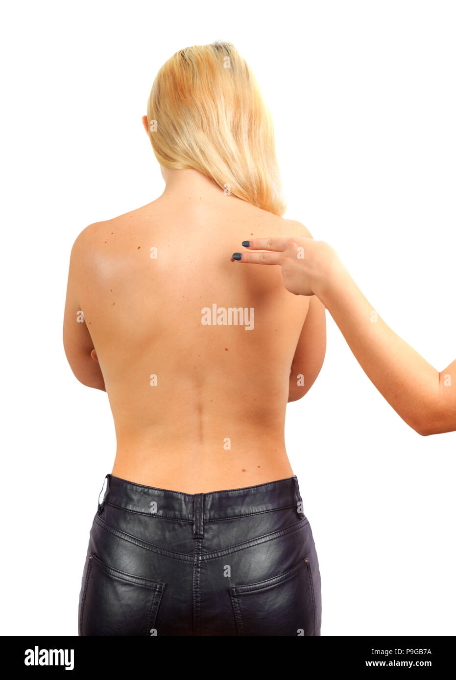 Female hand shows big birthmark on the female back. treatment of  birthmarks, papillomas, warts Stock Photo - Alamy