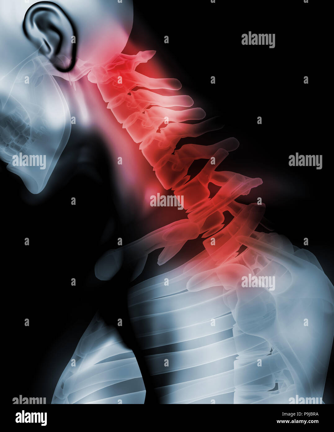 Cervical kyphosis hi-res stock photography and images - Alamy