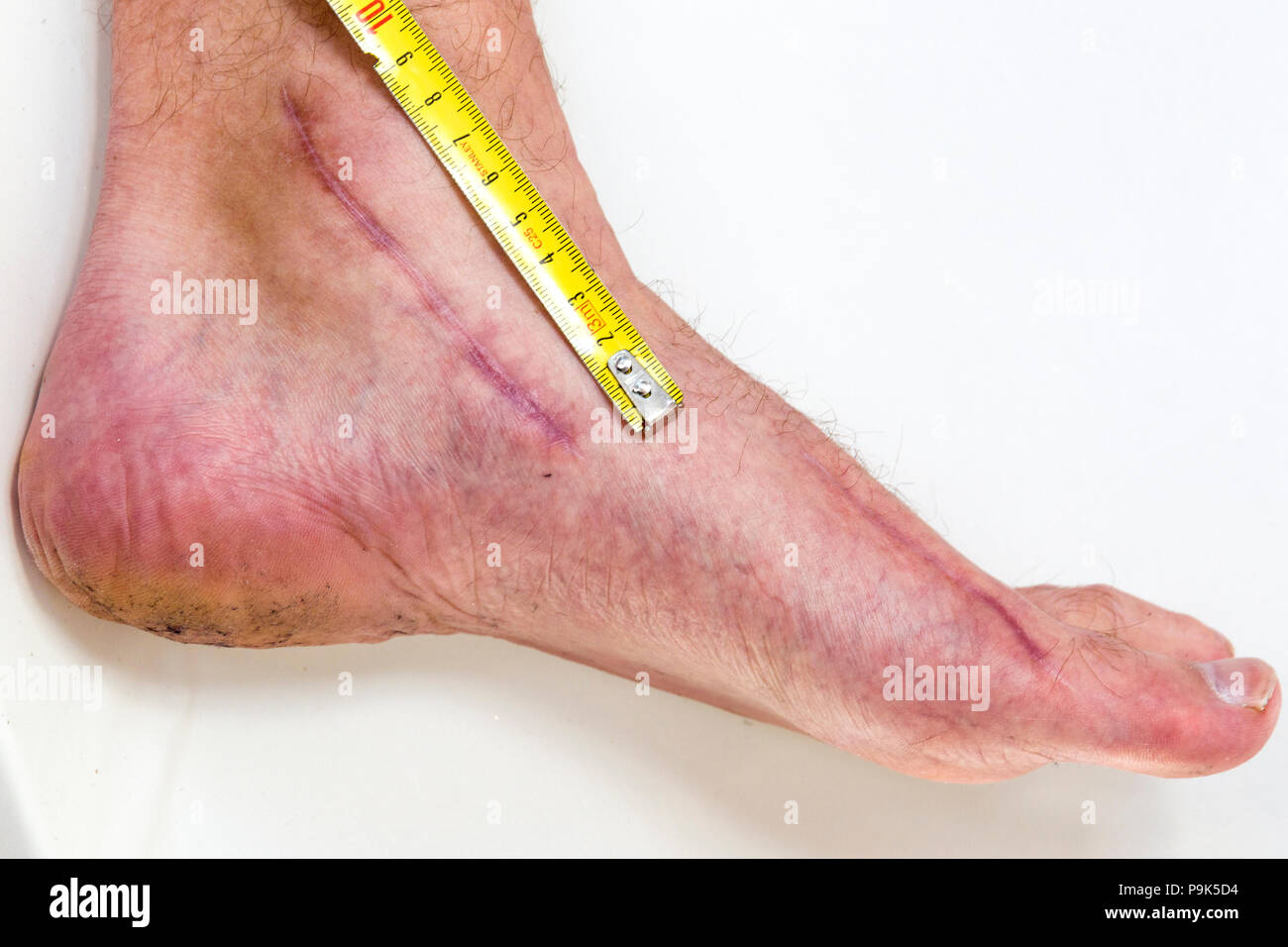 FLODA, SWEDEN - MAY 8 2017: Adult male person's post surgery scar and measuring tape on white background Stock Photo