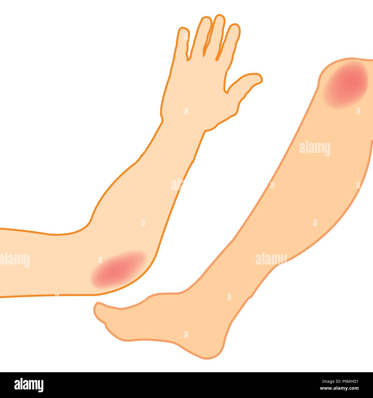 Bruise And Leg Stock Photos & Bruise And Leg Stock Images Alamy