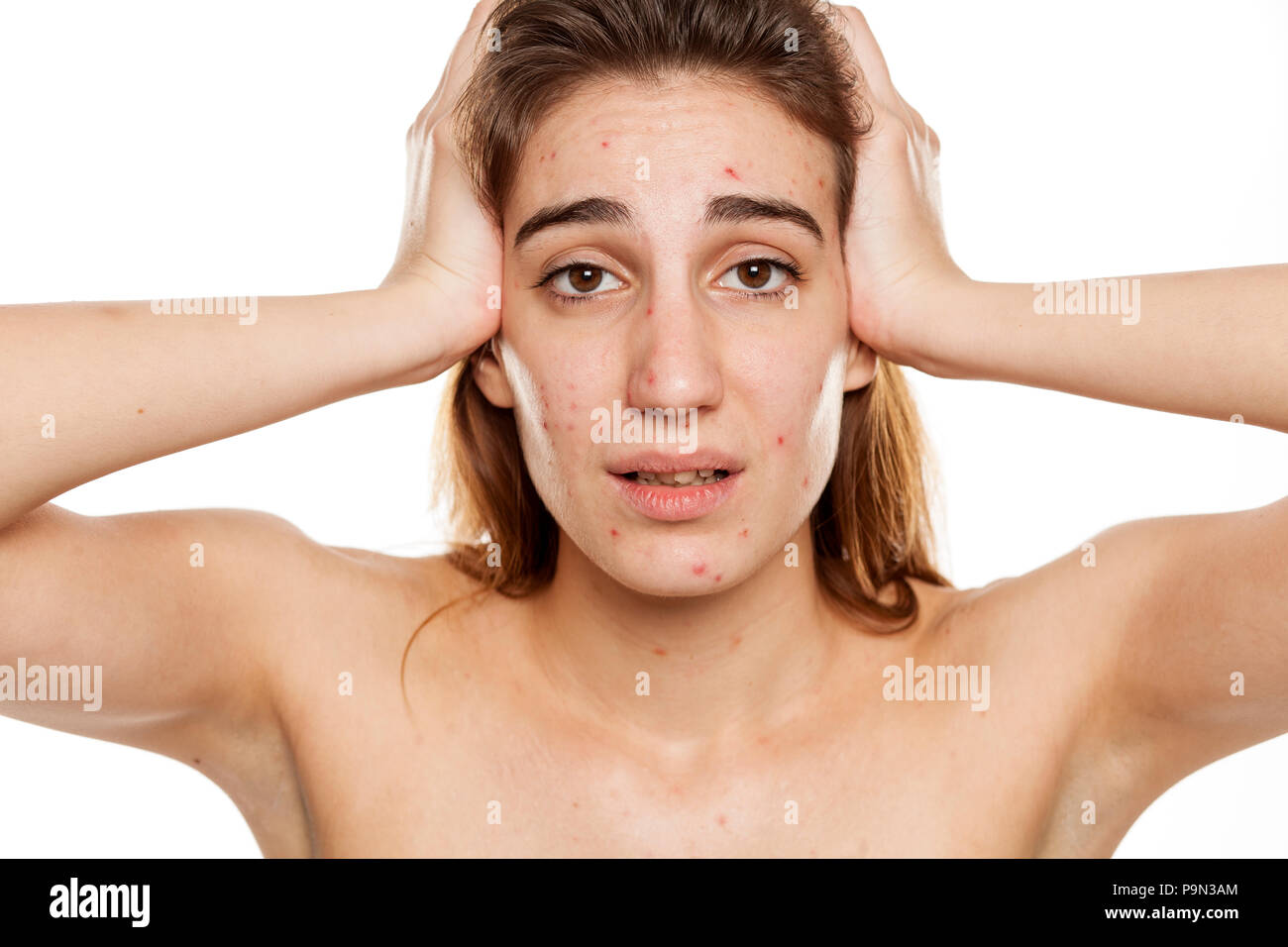 young unhappy woman with problematic skin and without makeup squeeze her acne on a white background Stock Photo