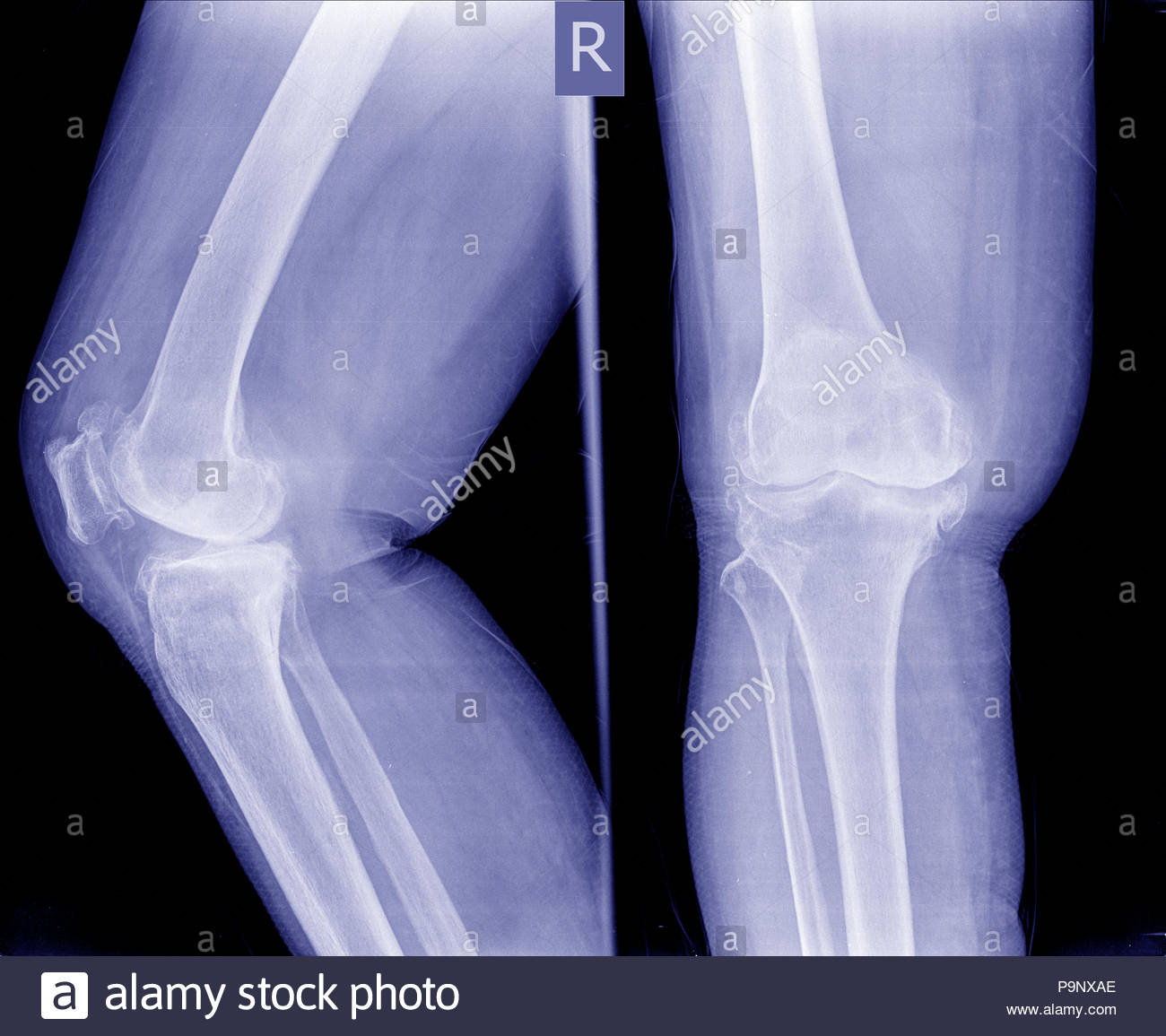 Bone Spur Stock Photos & Bone Spur Stock Images Alamy