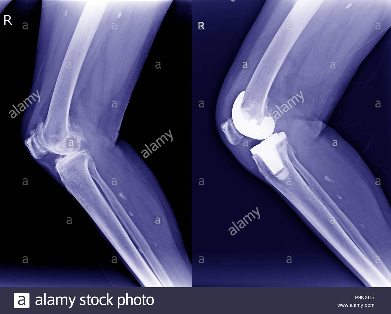 Osteoporosis Bone Scan Stock Photos & Osteoporosis Bone Scan Stock ...