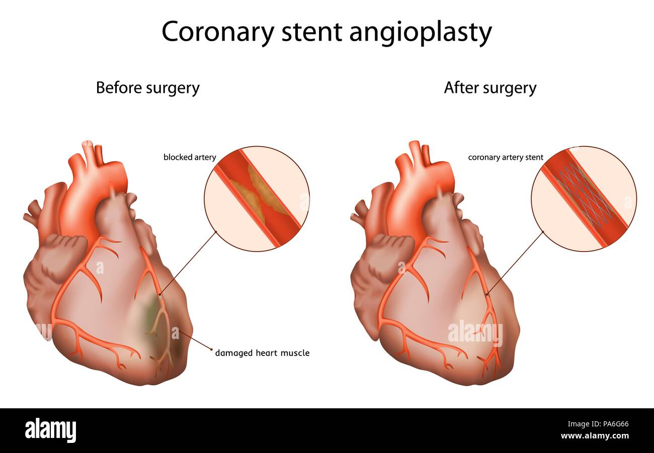Coronary stent angioplasty, illustration. The coronary stent opens a
