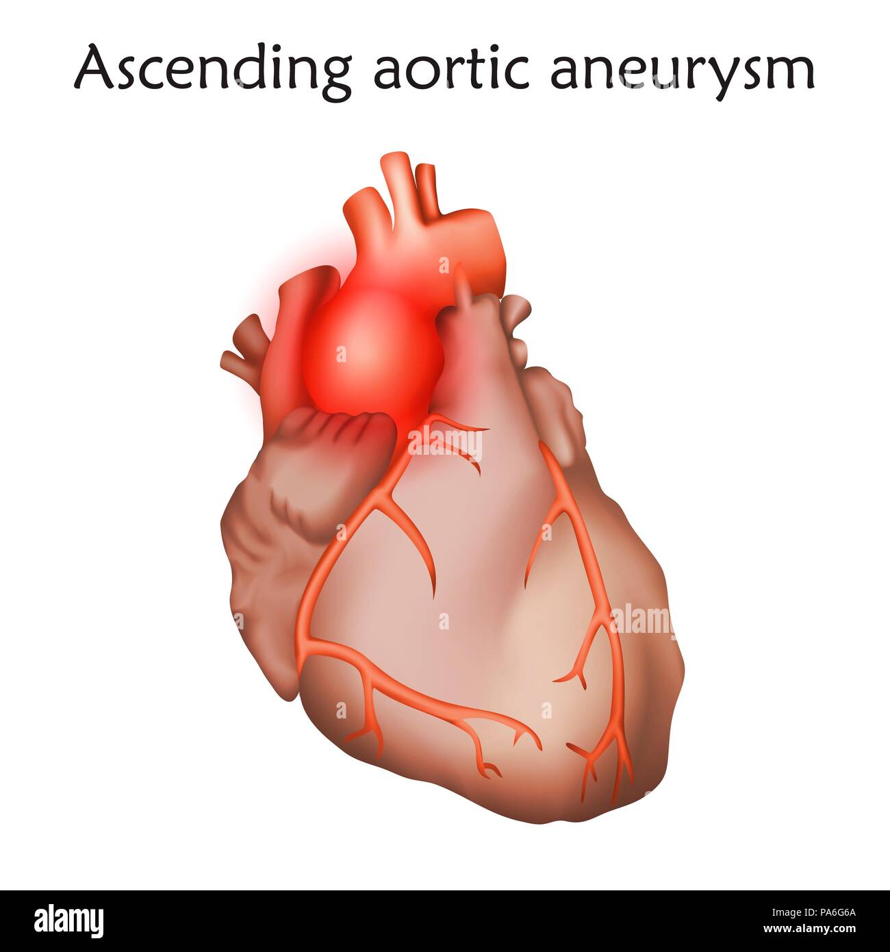 Ascending aortic aneurysm, illustration. Enlargement of a weakened area in the ascending aorta. Stock Photo