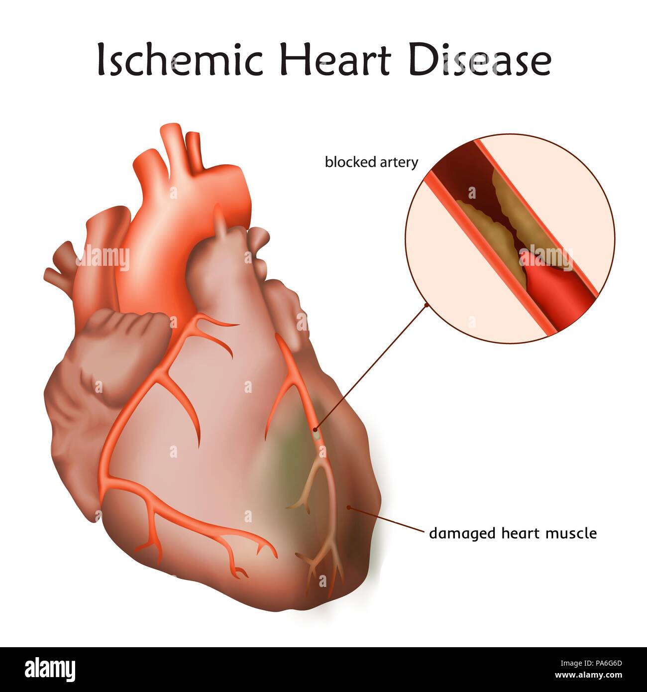 Ischemic heart disease, illustration. A blocked coronary artery has led to heart muscle damage. Stock Photo