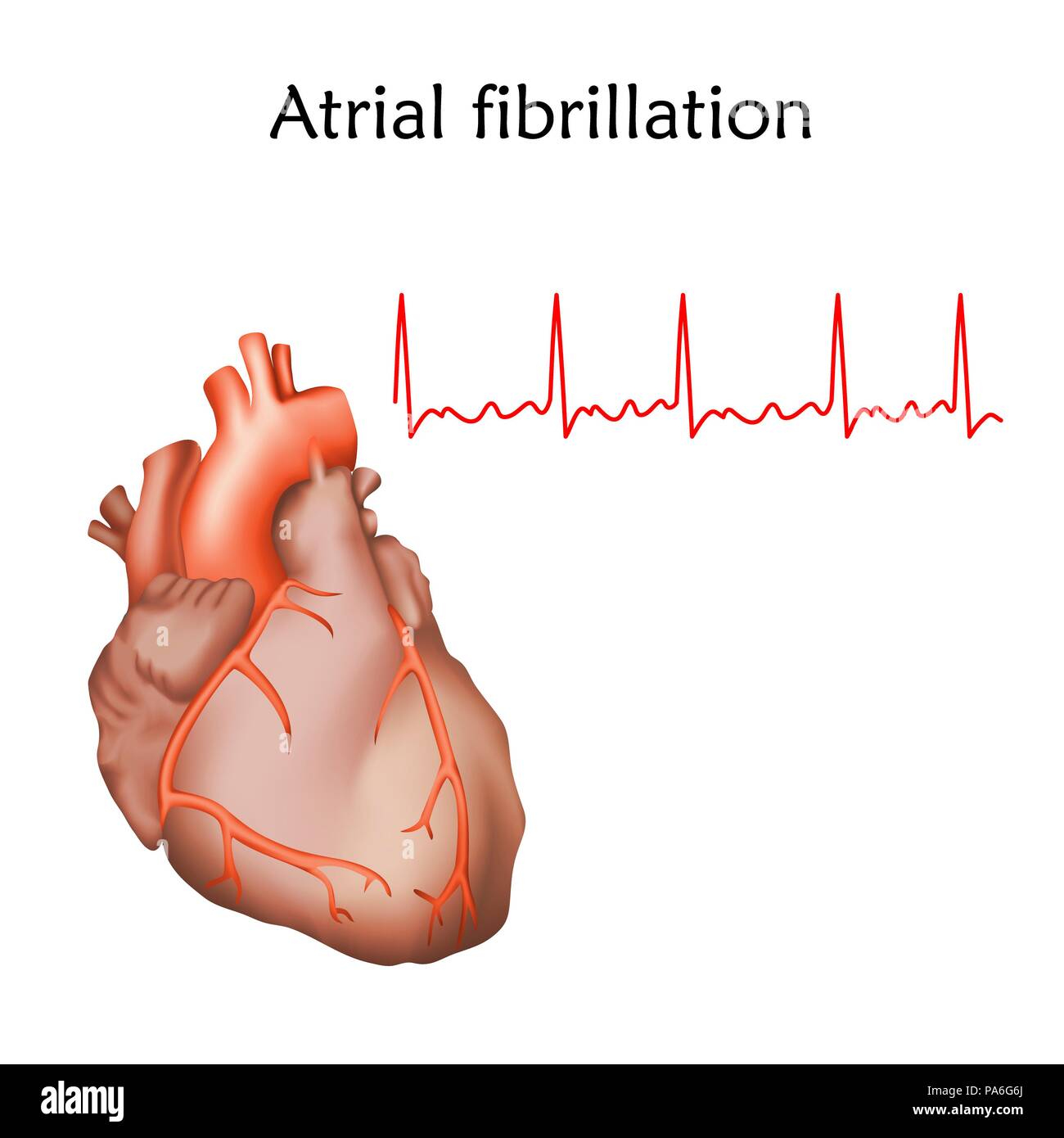 Atrial fibrillation, illustration. Stock Photo