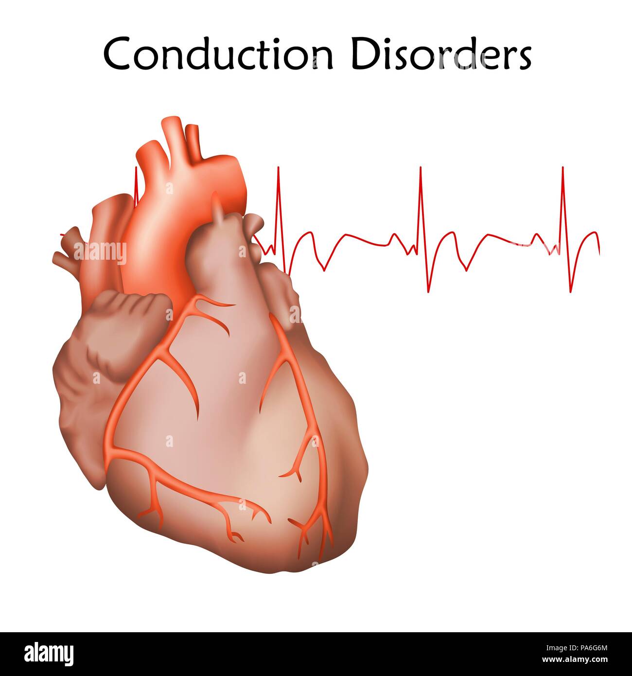Heart conduction disorders, illustration. Stock Photo