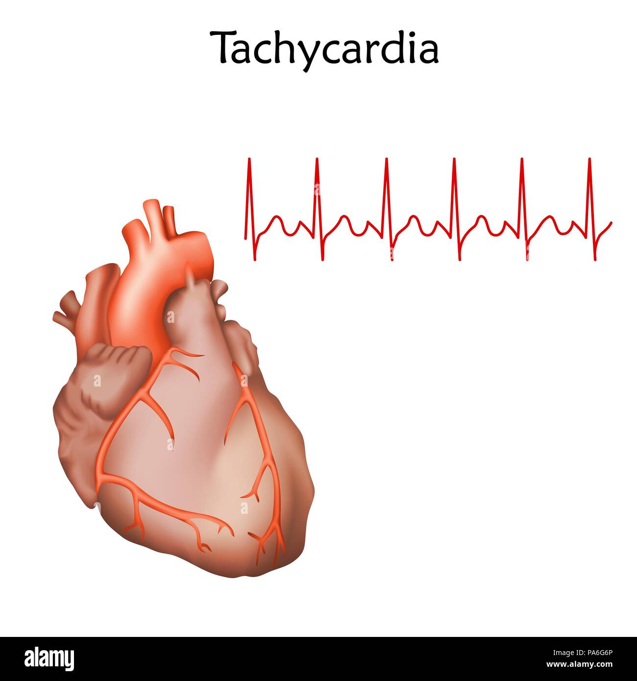  Tachycardia Illustration Stock Photo Alamy