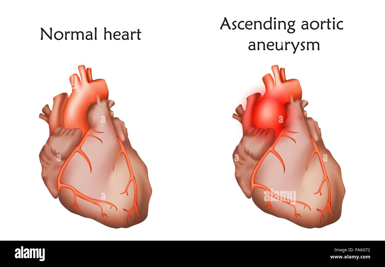 Ascending aortic aneurysm, illustration. Comparison between a damaged and normal heart. Stock Photo