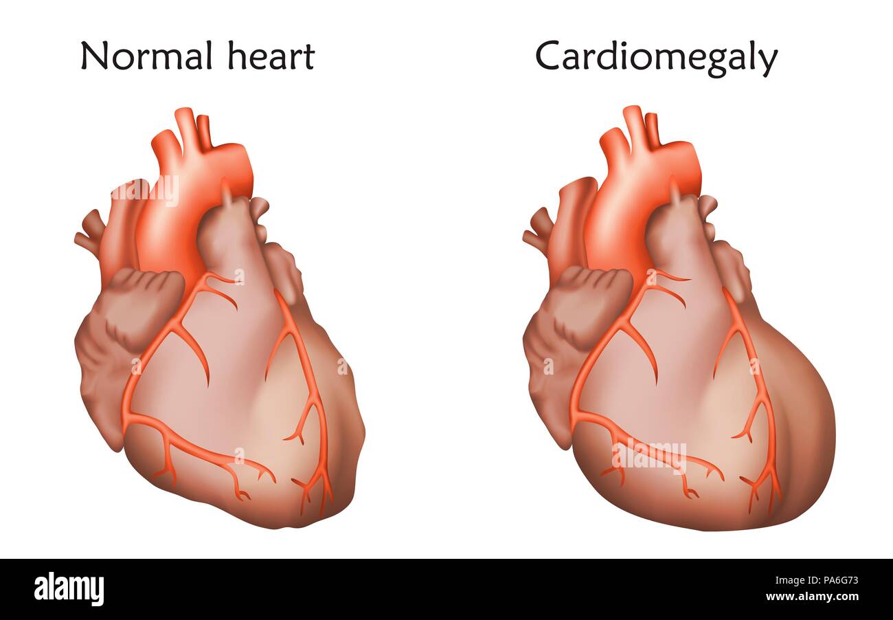 Cardiomegaly, illustration. Comparison between an enlarged and normal heart. Stock Photo