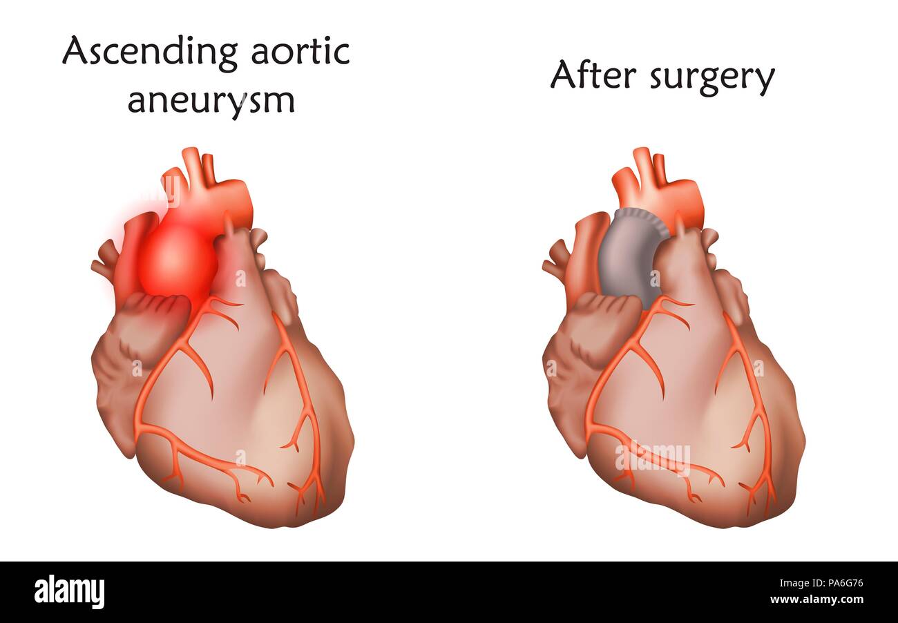 Ascending aortic aneurysm before and after repair with a tube graft, illustration. Stock Photo