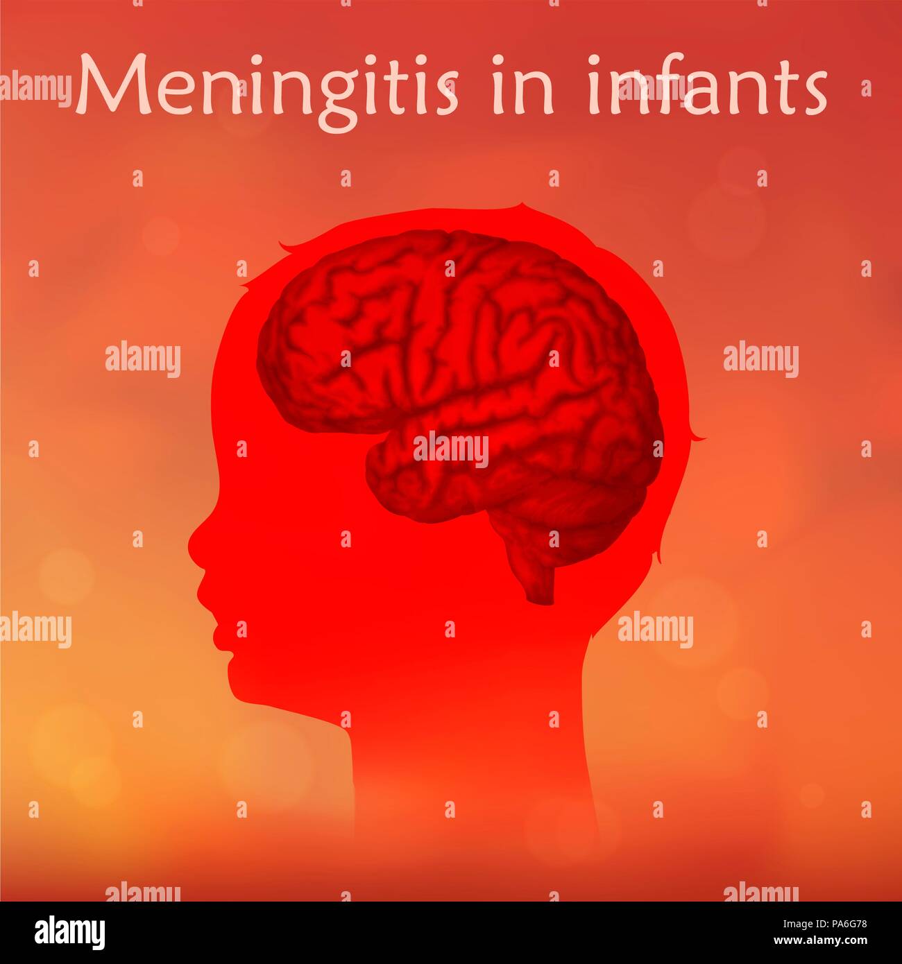 Childhood meningitis, illustration. Meningitis is an acute inflammation of  the protective membranes covering the brain and spinal cord Stock Photo -  Alamy
