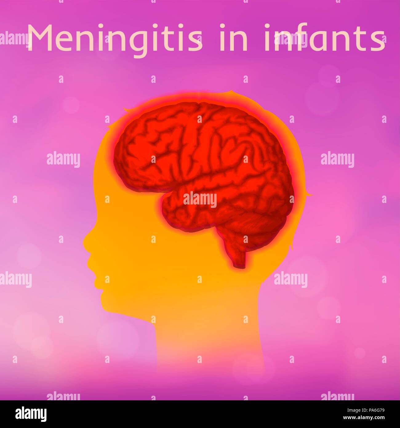 Childhood meningitis, illustration. Meningitis is an acute inflammation