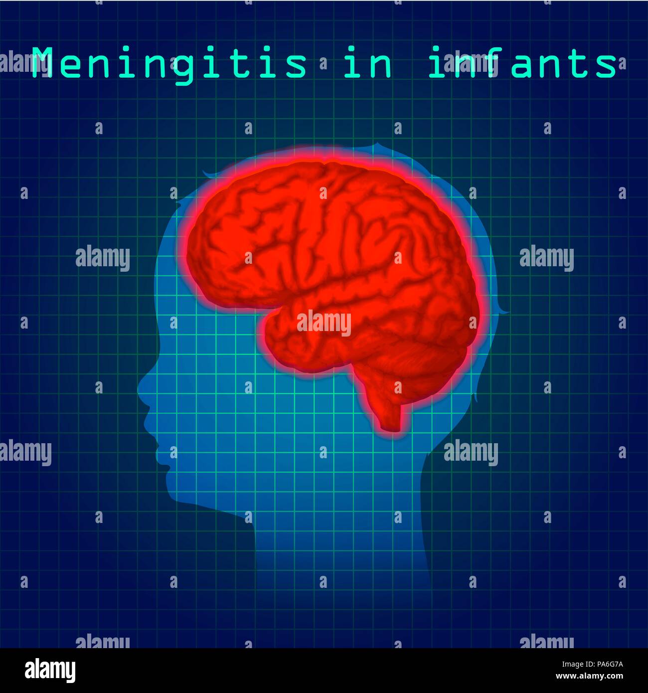 Childhood meningitis, illustration. Meningitis is an acute inflammation