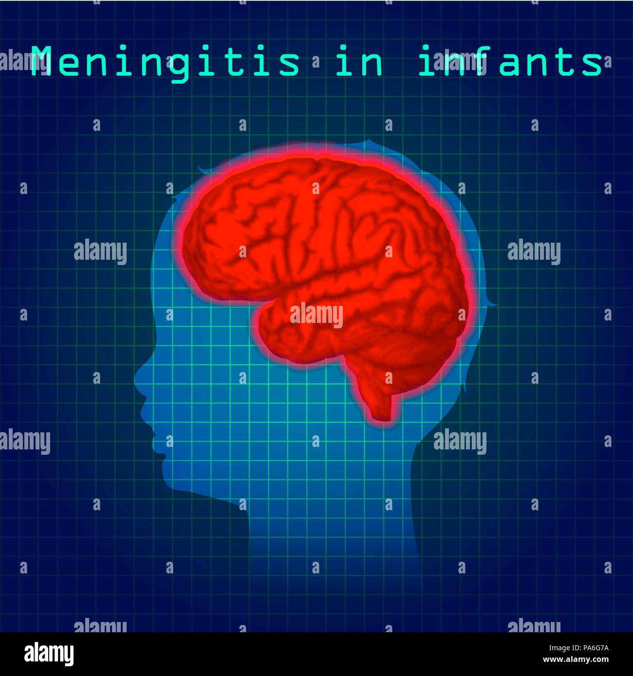 Childhood meningitis, illustration. Meningitis is an acute inflammation of the protective membranes covering the brain and spinal cord. Stock Photo