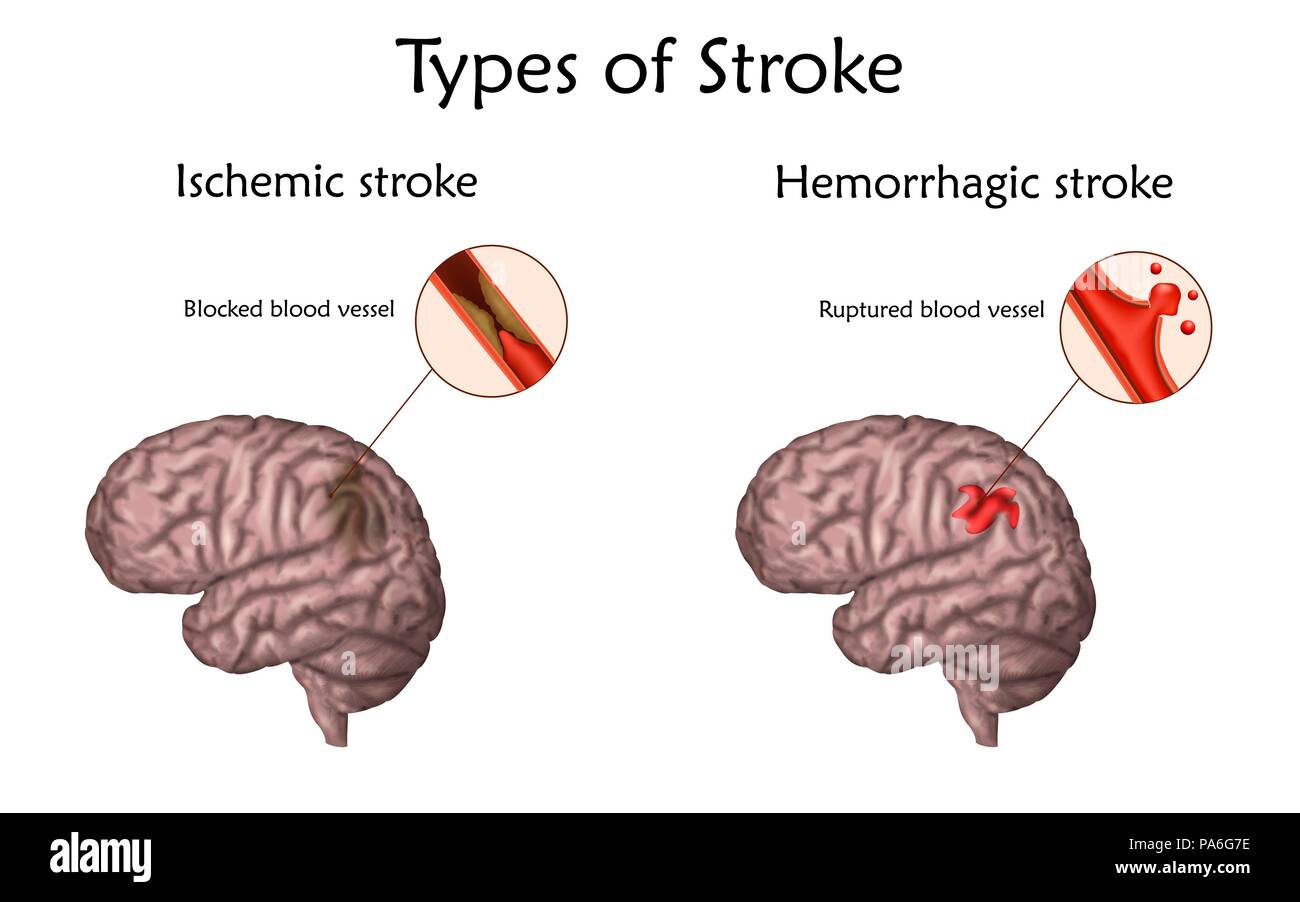 Different types of strokes