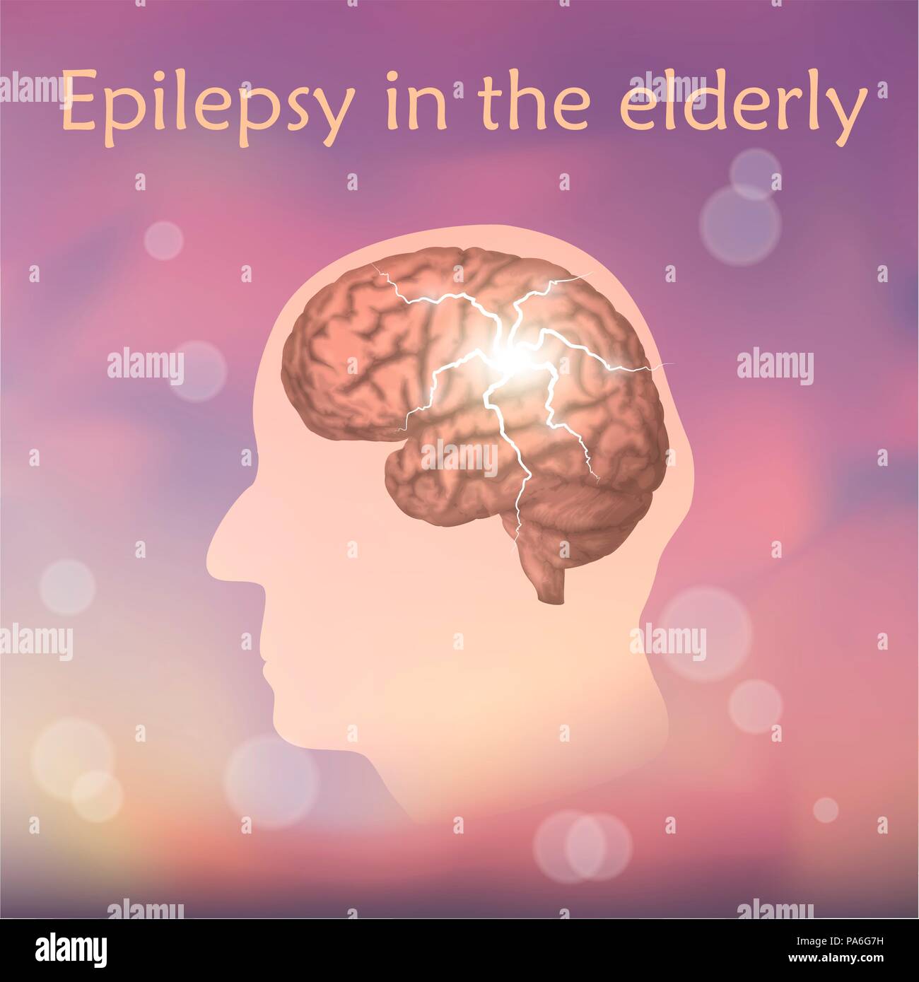 Epilepsy in the elderly, illustration. Electrical discharge in an old man's brain. Stock Photo