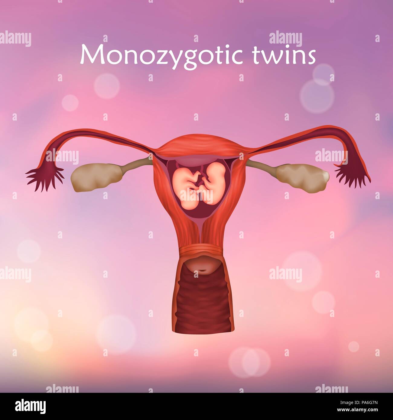 Multiple pregnancy, illustration. Monozygotic twins in the uterus