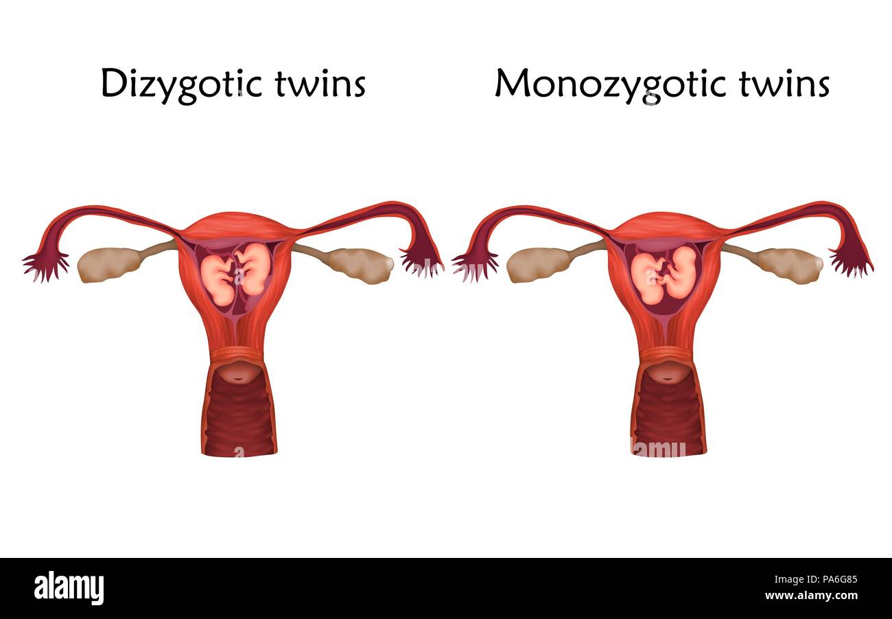 Multiple pregnancy, illustration. Dizygotic and monozygotic twins