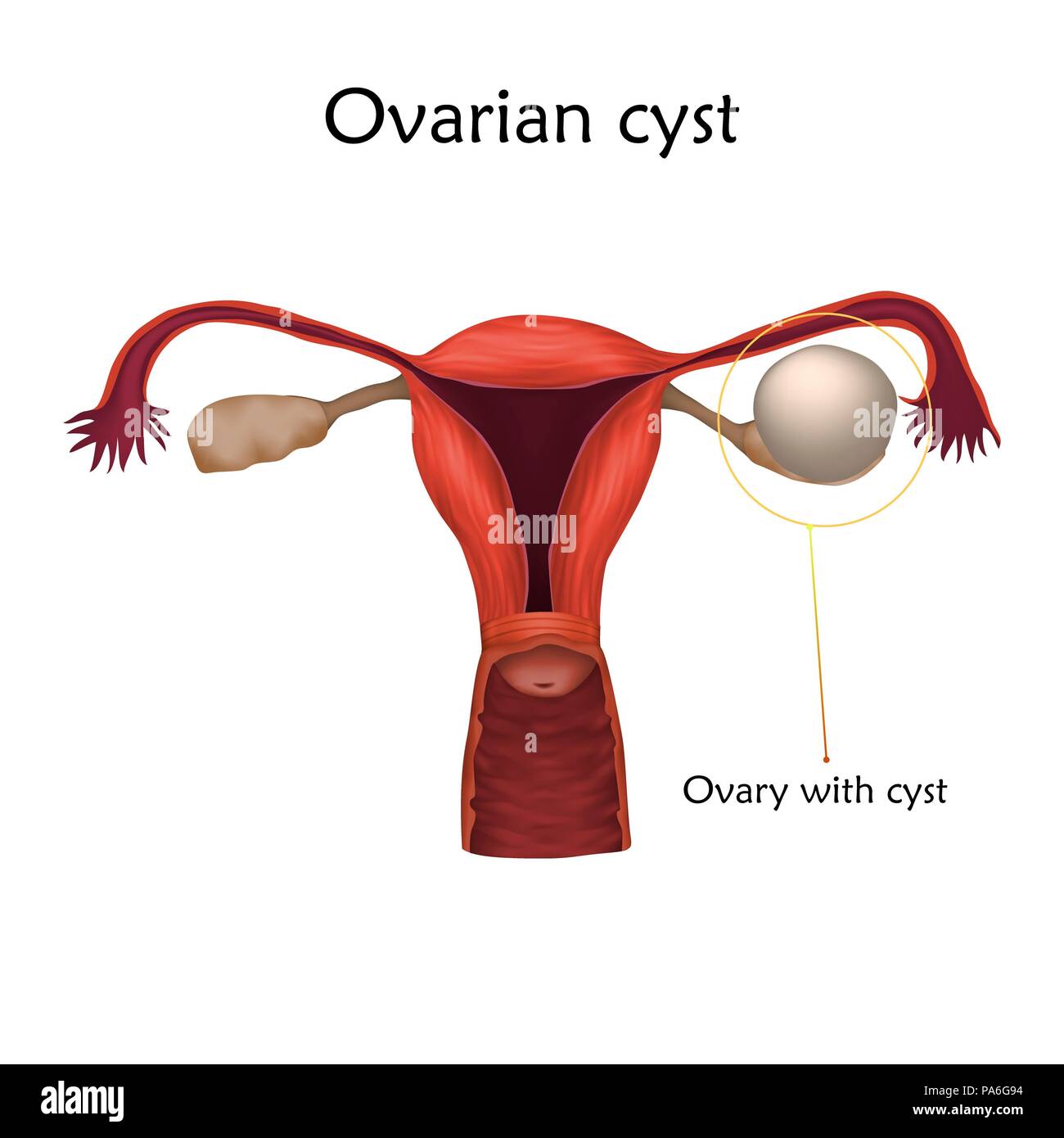 Ovarian cyst, illustration. An ovarian cyst is a fluid-filled sac within the ovary. Stock Photo