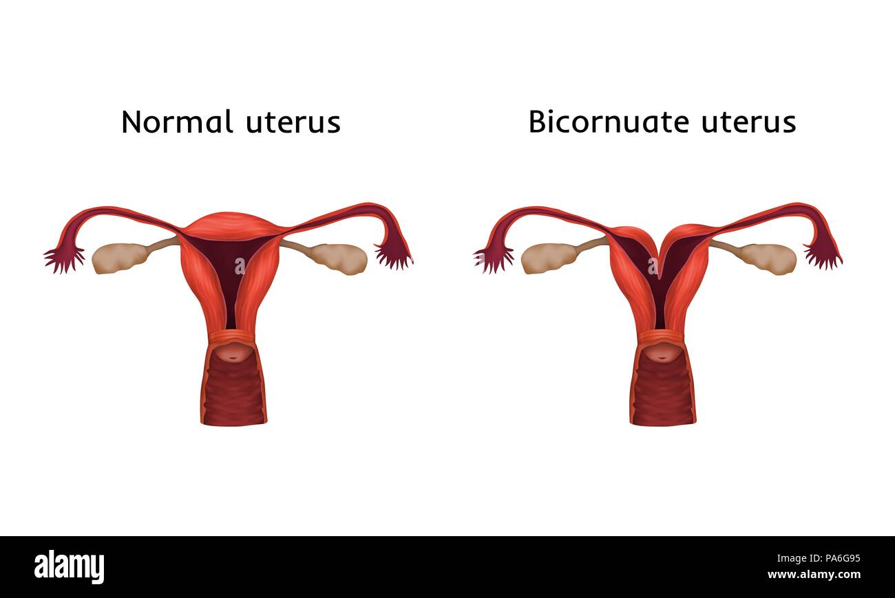 Bicornuate uterus and normal uterus comparison, illustration. A bicornuate uterus is composed of two horns separated by a septum. Stock Photo
