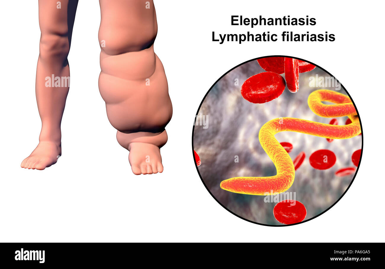 Elephantiasis in leg hi-res stock photography and images - Alamy
