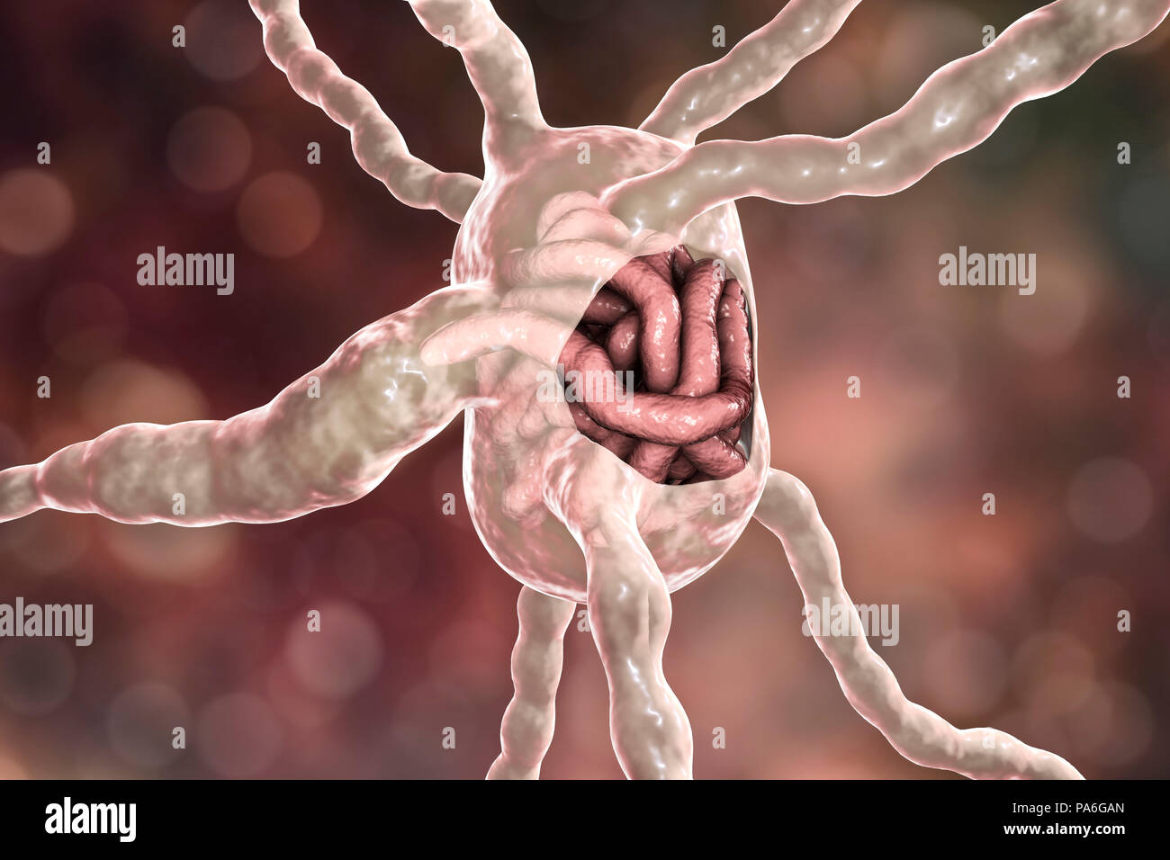 Lymph node with filaria worms, illustration. Filaria are parasitic nematode worms transmitted in larval form by the bite of mosquitoes, they cause elephantiasis, also known as lymphatic filariasis. The larvae develop into adult worms (macrofilariae) that lodge in and block the lymphatic system, which is shown in the image. This causes lymph fluid to accumulate in the limbs, a form of lymphoedema. Elephantiasis is rarely fatal, but causes widespread suffering in tropical regions. Treatment involves drug therapy and rigorous hygiene to prevent skin infections. Stock Photo