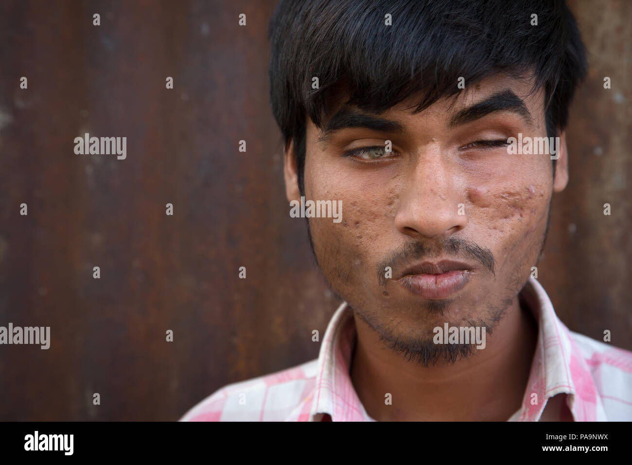 Disabled and blind man living in Arif Nagar, near the abandoned Union Carbide industrial complex, Bhopal, India Stock Photo