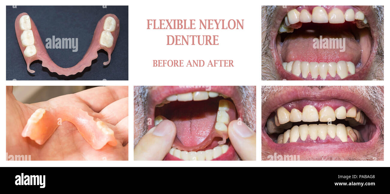 Clasp prosthesis for upper jaw Clasp prosthesis for upper jaw
