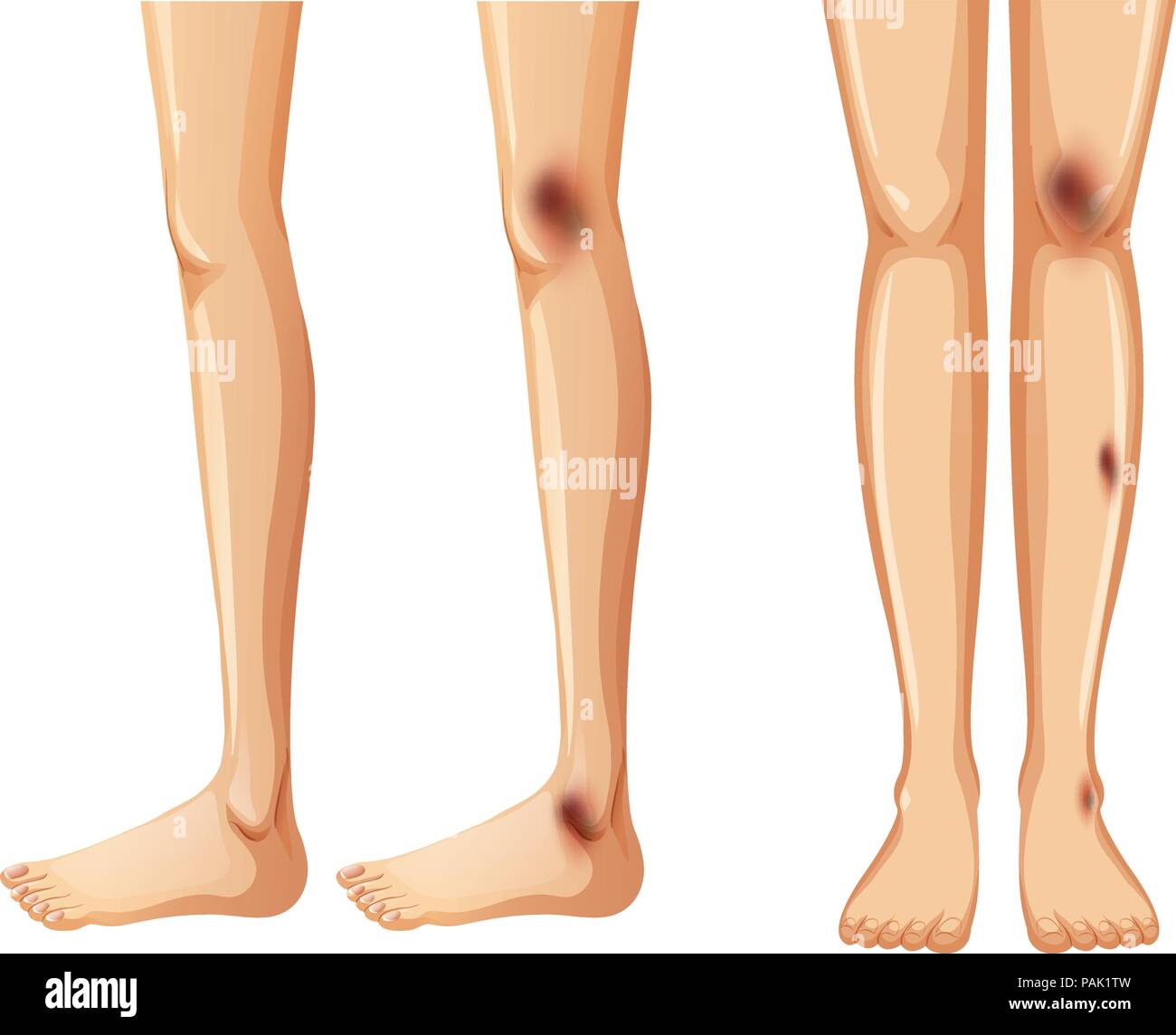 Side and front of bruises on leg illustration Stock Vector