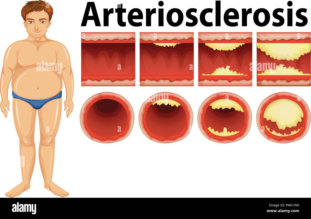 A fat man with atherosclerosis illustration Stock Vector