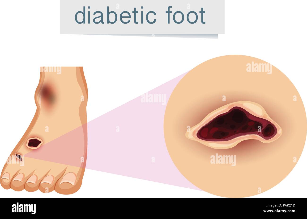 A human foot with diabetic  illustration Stock Vector