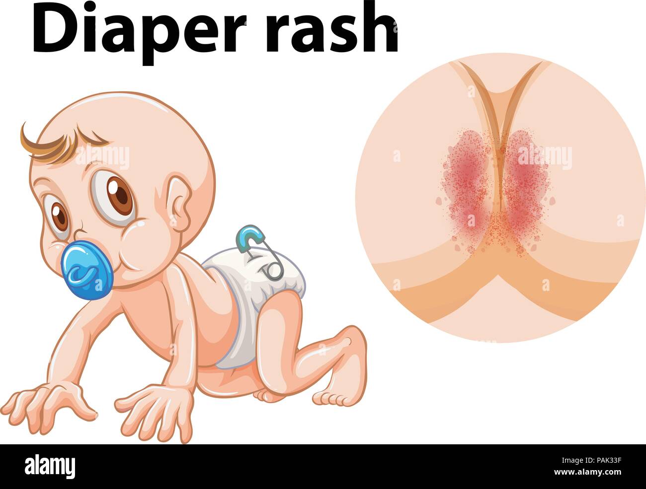A baby with diaper rash illustration Stock Vector