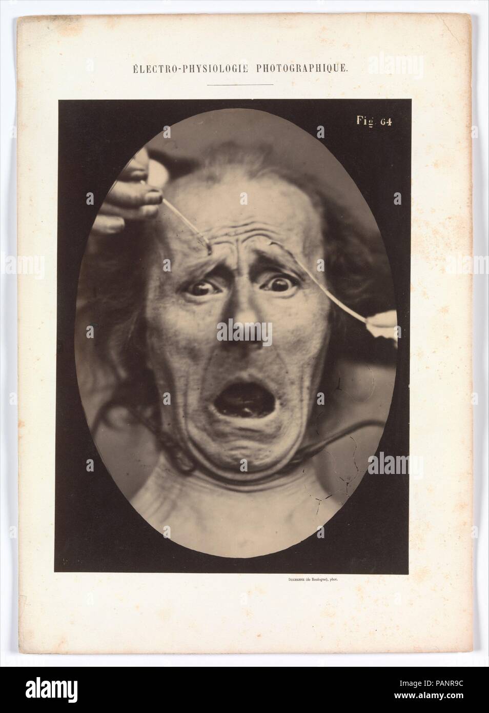 Electro-Physiologie, Figure 64. Artist: Guillaume-Benjamin-Amand Duchenne de Boulogne (French, 1806-1875); Adrien Tournachon (French, 1825-1903). Dimensions: Image: 29.8 x 22.3 cm (11 3/4 x 8 3/4 in.)  Mount: 40.1 x 28.5 cm (15 13/16 x 11 1/4 in.). Date: 1854-56, printed 1862.  In compiling a scientific treatise to aid artists, the physiologist Duchenne de Boulogne used electrical stimulation of the facial muscles to elicit expressions of the principal emotions. Wanting his transcriptions to be exact, he collaborated with Adrien Tournachon (brother of the famous Nadar), a photographer who spec Stock Photo