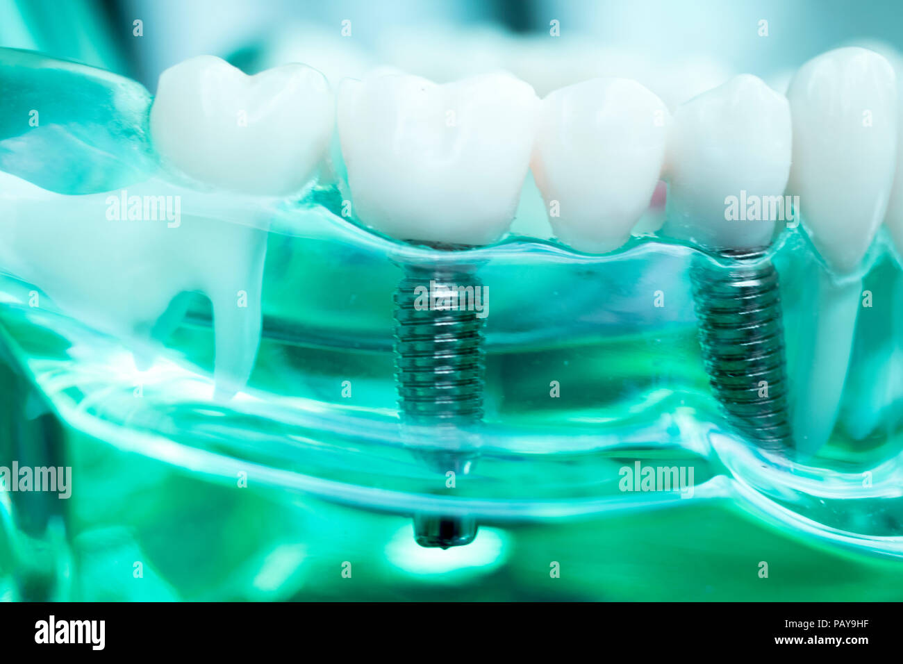 Dentist dental teeth teaching model showing titanium metal tooth