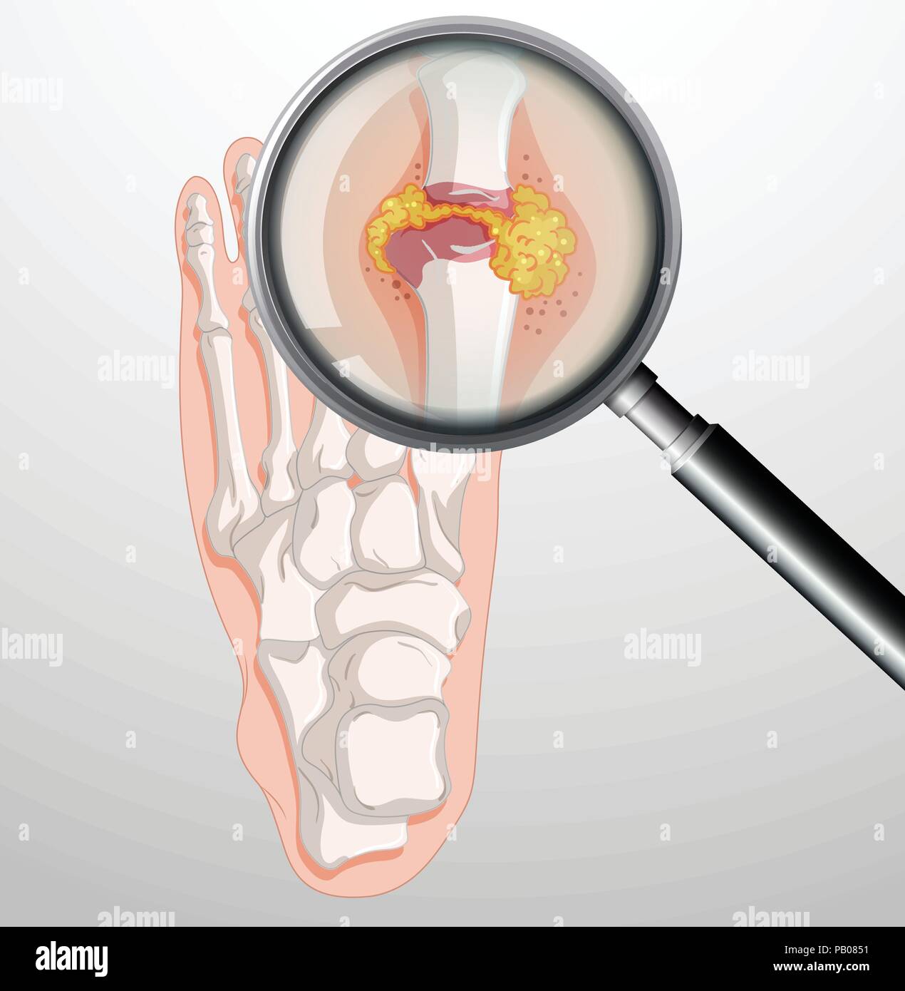 Human feet with gout illustration Stock Vector Image & Art - Alamy
