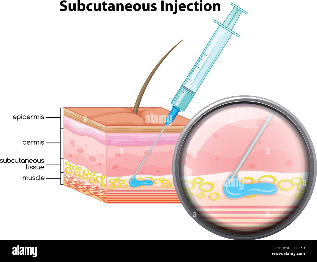 Skin Subcutaneous Injection Diagram Illustration Stock Vector Image Skin Subcutaneous Injection Diagram Illustration Stock Vector Image