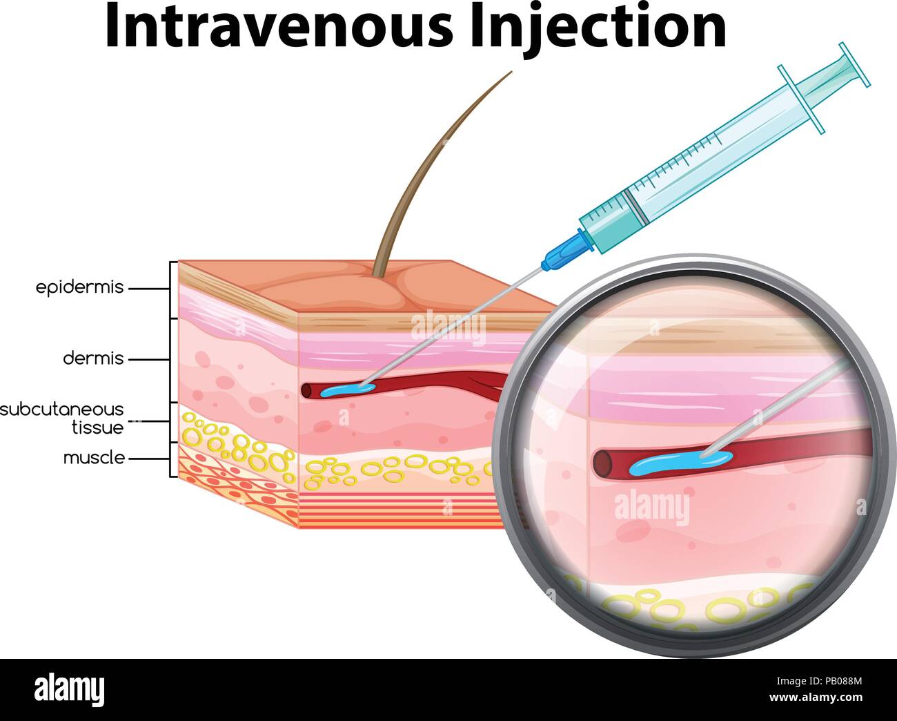 Intravenous injection on white background illustration Stock Vector