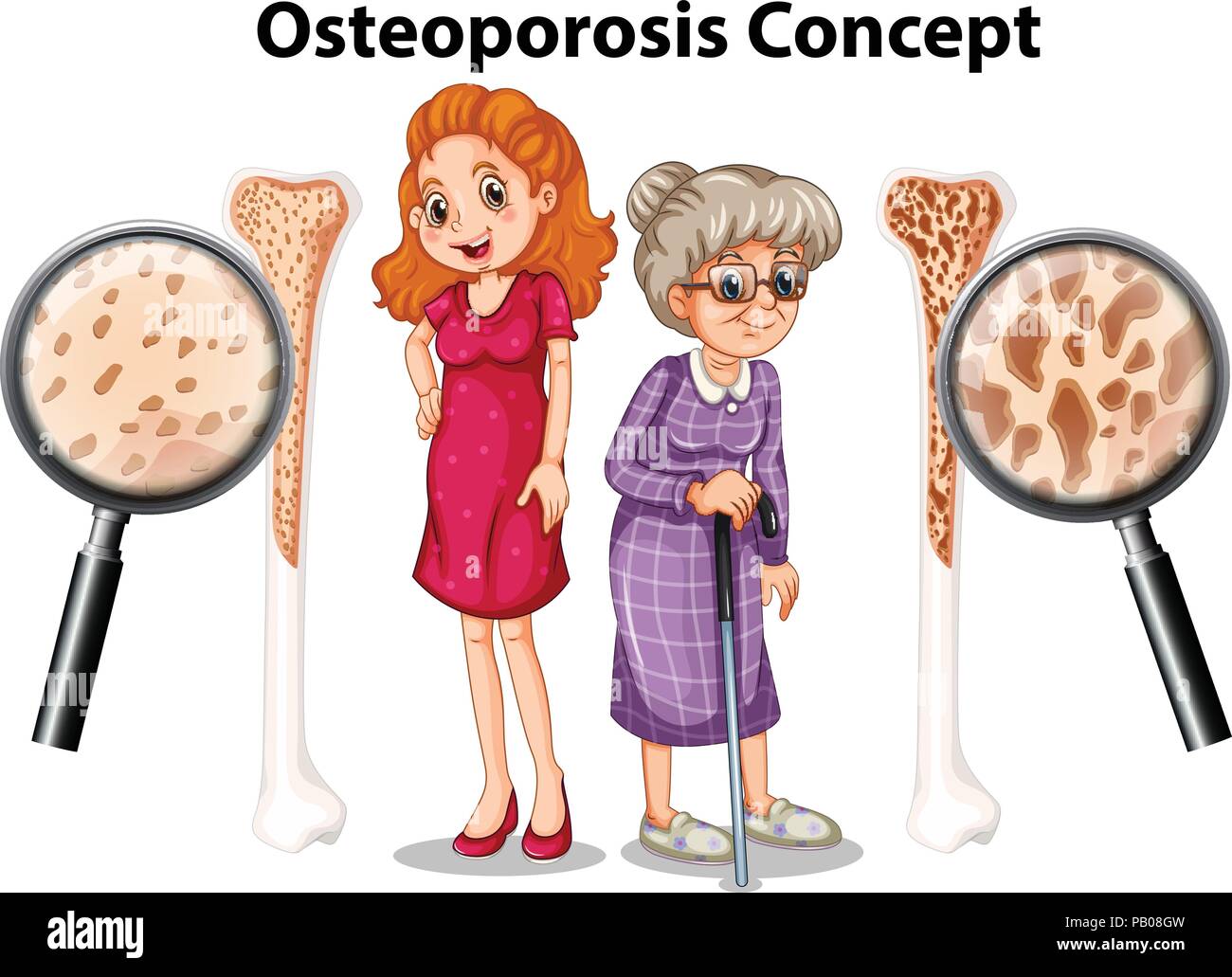 Osteoporosis concept on white background illustration Stock Vector Image &  Art - Alamy