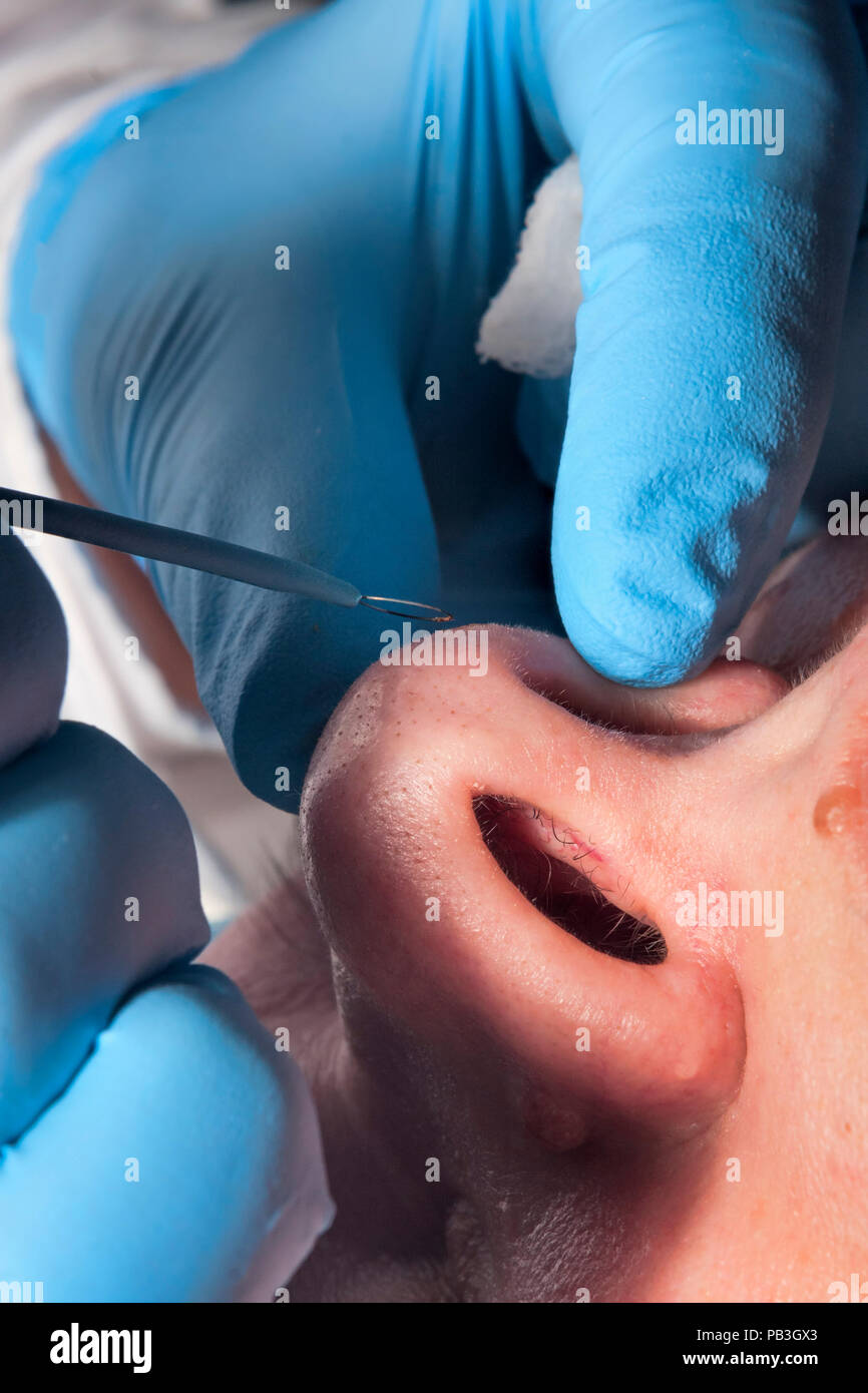Dermatologist surgeon removes skin problems in the nose using electrocoagulation Stock Photo