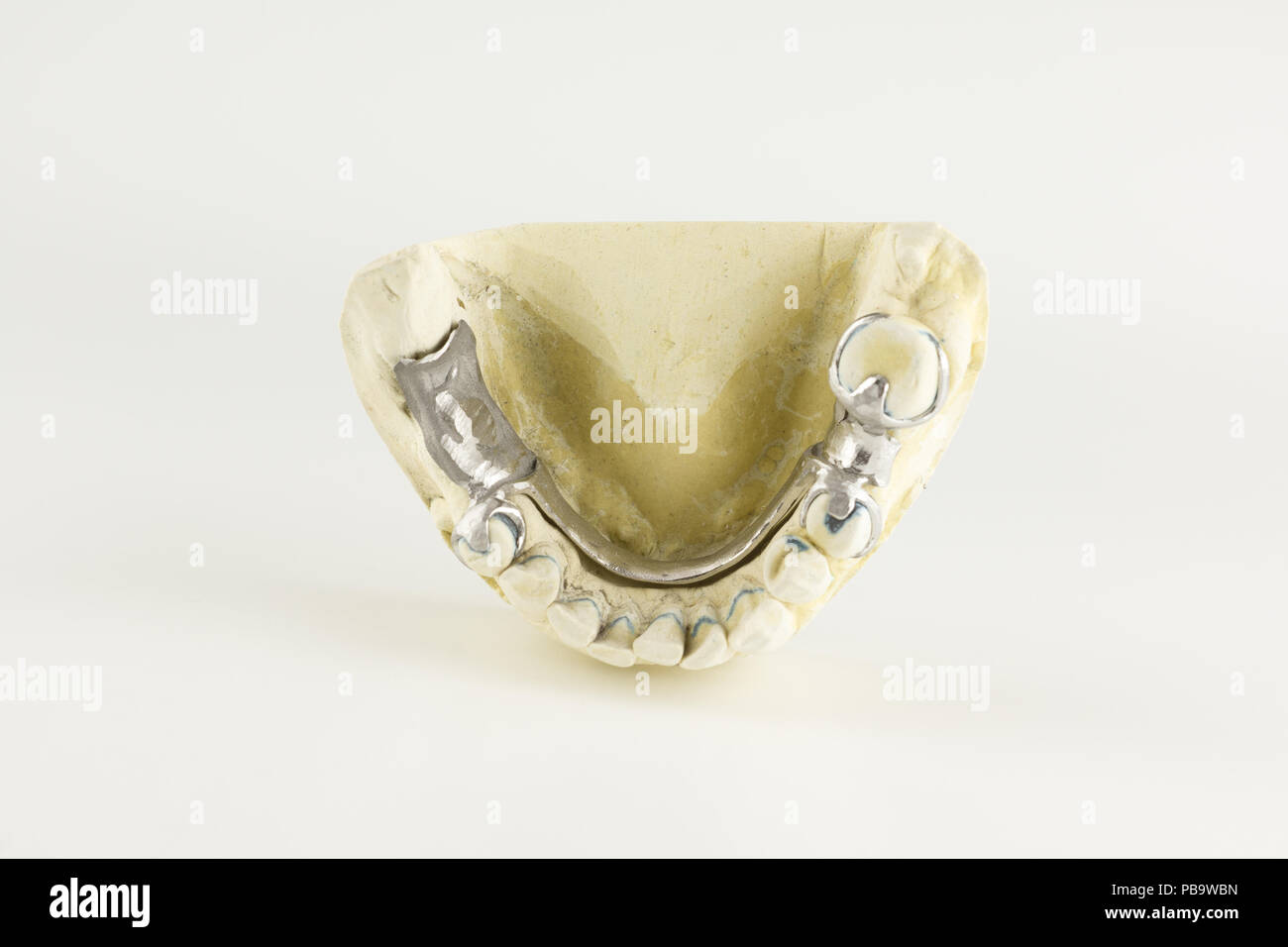 steel base of the clasp prosthesis on the gypsum model Stock Photo - Alamy