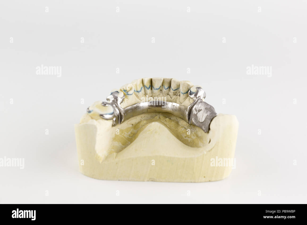 steel base of the clasp prosthesis on the gypsum model Stock Photo - Alamy