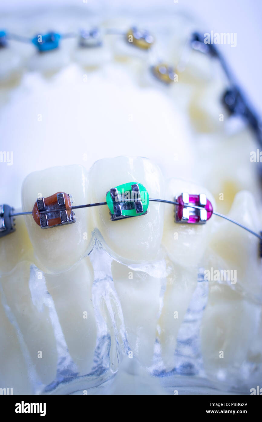 Dental metal braces teeth retainer aligners teaching orthodontics model