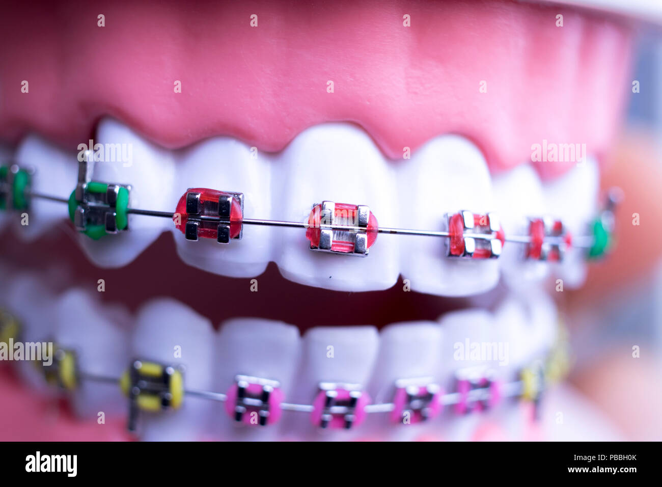 Dental metal braces teeth retainer aligners teaching orthodontics model