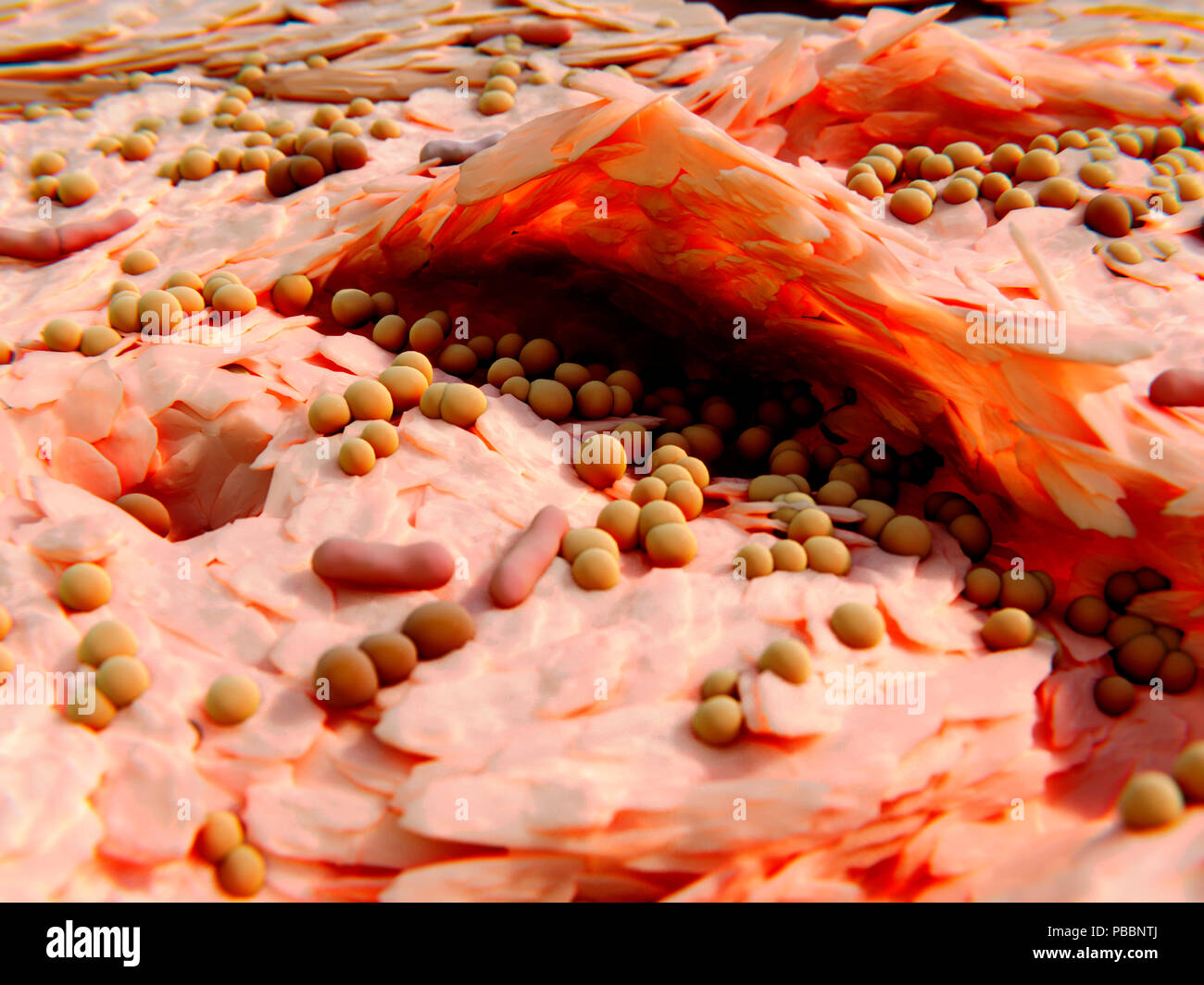 Staphylococcal neurodermatitis. Illustration of bacterial infection of