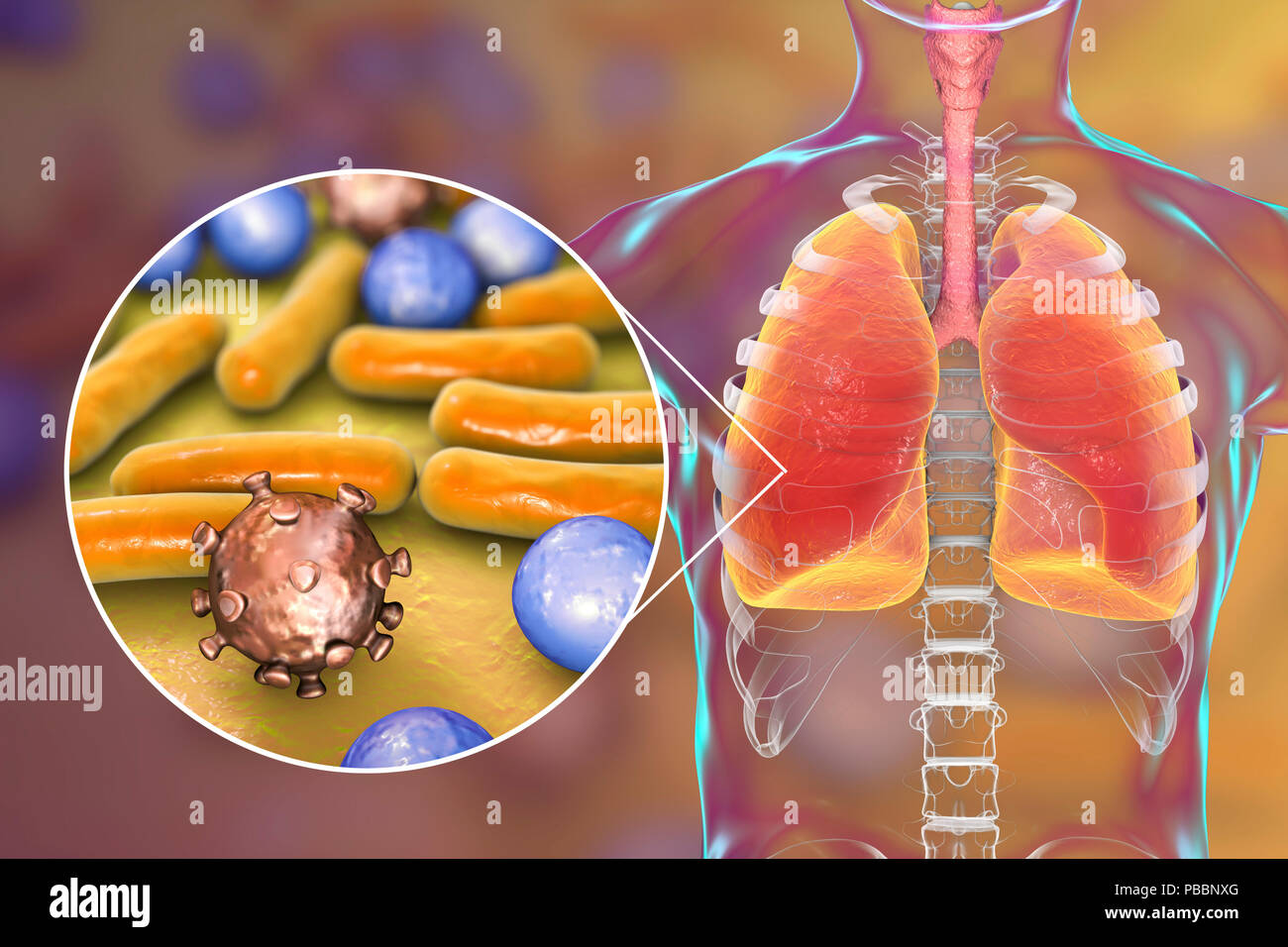 Pneumonia of mixed etiology, conceptual illustration. Human lungs and close-up view of bacteria and viruses, two of the causative agents of pneumonia. Stock Photo