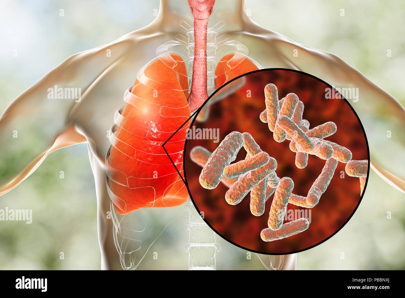 Bacterial pneumonia, conceptual illustration. Human lungs and close-up view of bacteria, one of the causative agents of pneumonia. Stock Photo